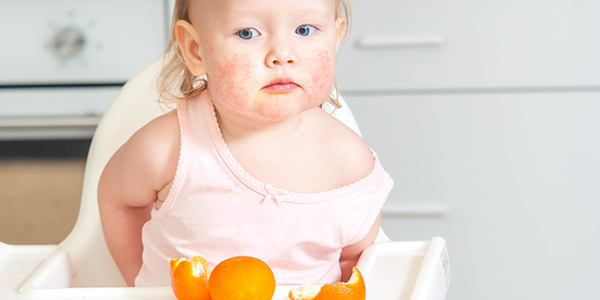 Food Allergies in Child